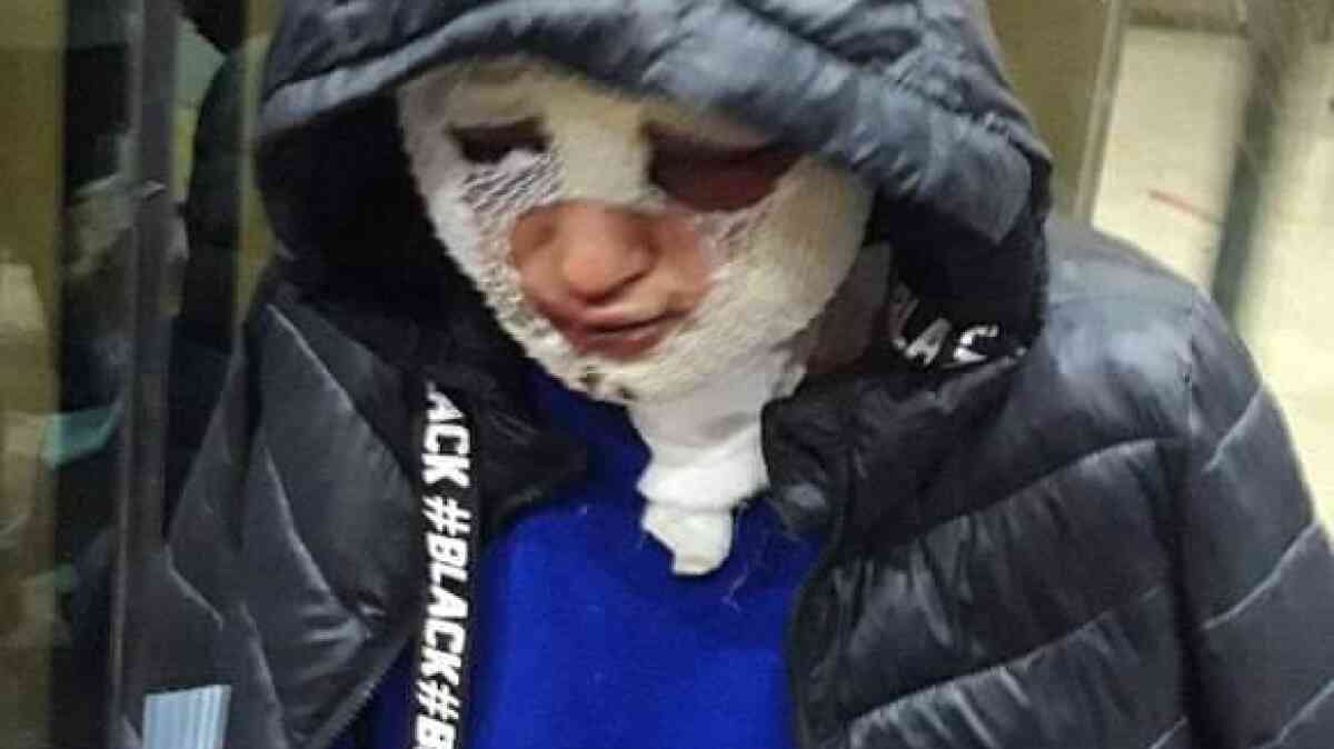 Hatay'da eski erkek arkadaşının yüzüne kızgın yağ döktüğü kadın yaralandı